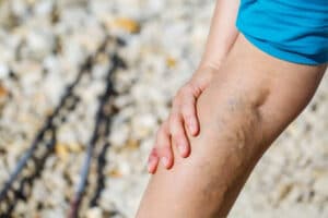 Home Care Services in San Clemente CA: Deep Vein Thrombosis